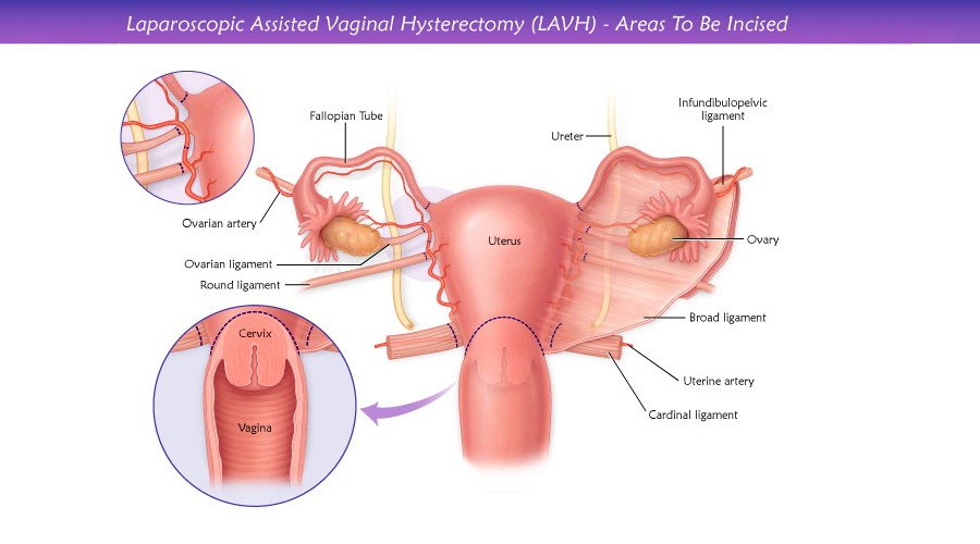 Hysterectomy - vaginal - discharge Information