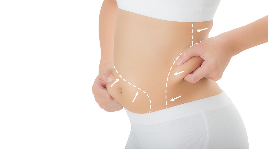 Bra And Back Liposuction